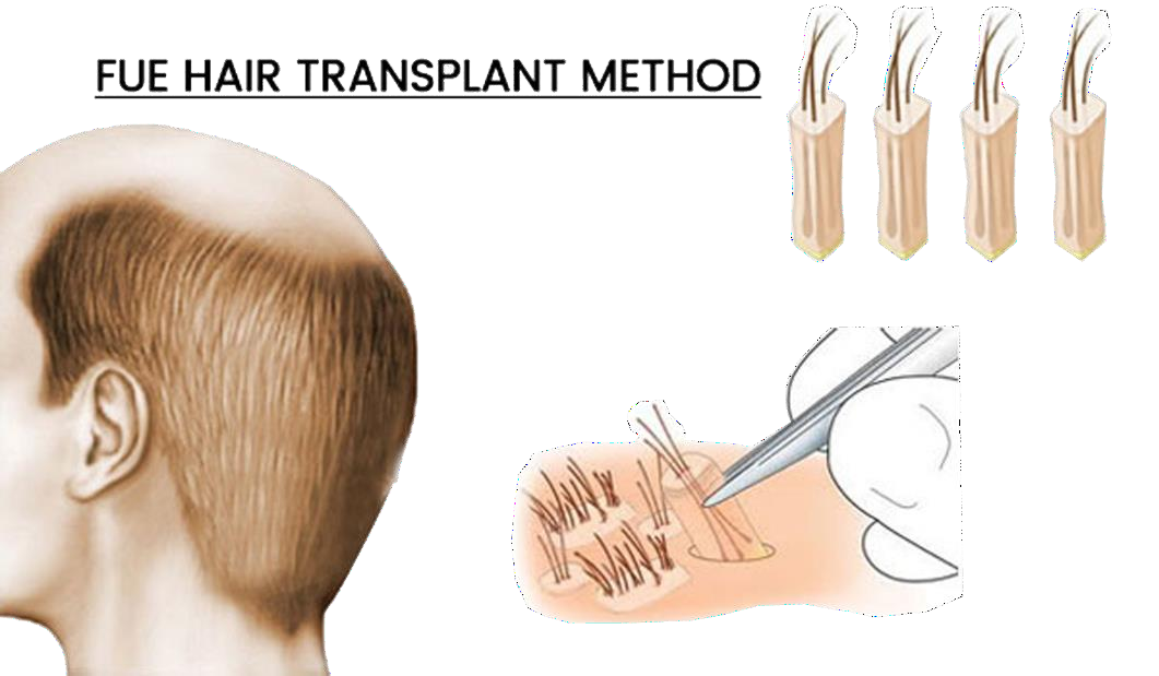 Hair Transplant in Bangalore | Hair Transplant Cost in Bangalore | Hair Transplantation in Bangalore - Dr Shetty's Cosmetic Clinic Hair Transplant in Bangalore | Hair Transplant Cost in Bangalore | Hair Transplantation in Bangalore - Dr Shetty's Cosmetic Clinic