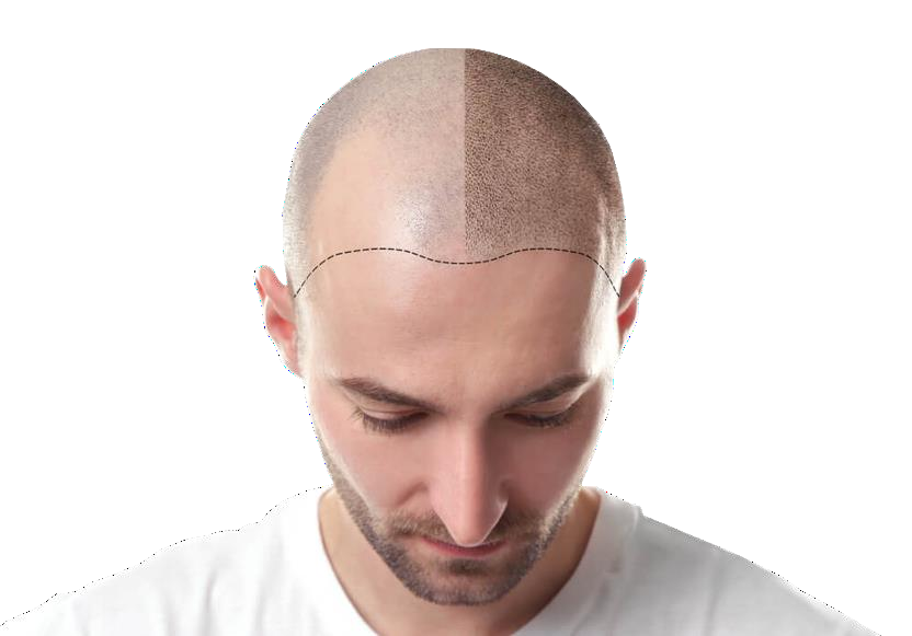 Hair Transplant in Bangalore | Hair Transplant Cost in Bangalore | Hair Transplantation in Bangalore - Dr Shetty's Cosmetic Clinic Hair Transplant in Bangalore | Hair Transplant Cost in Bangalore | Hair Transplantation in Bangalore - Dr Shetty's Cosmetic Clinic