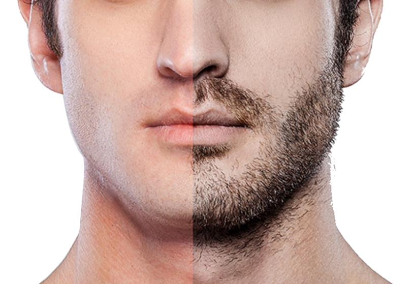 Beard/ Moustache Hair Transplant Bangalore - Dr. Shetty's Cosmetic Clinic Beard/ Moustache Hair Transplant Bangalore - Dr. Shetty's Cosmetic Clinic