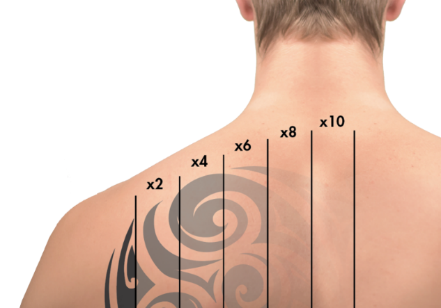 Tattoo Removal Surgery in Bangalore - Dr. Shettys Cosmetic Clinic