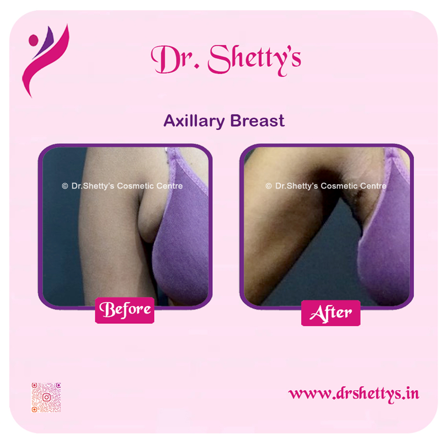 Axillary Breast Surgery 1