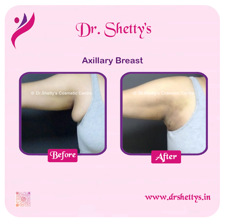Axillary Breast Surgery 2