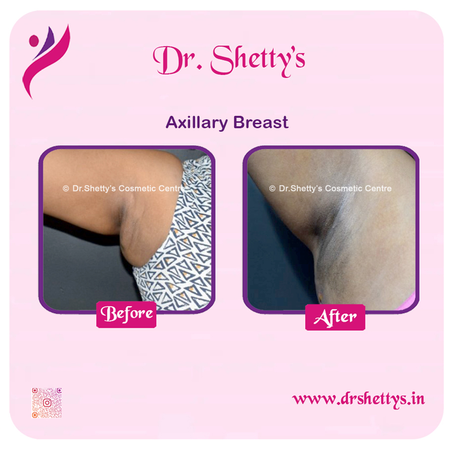 Axillary Breast Surgery 3