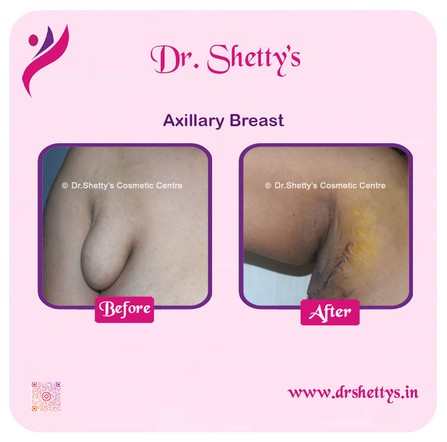 Axillary Breast Surgery 4