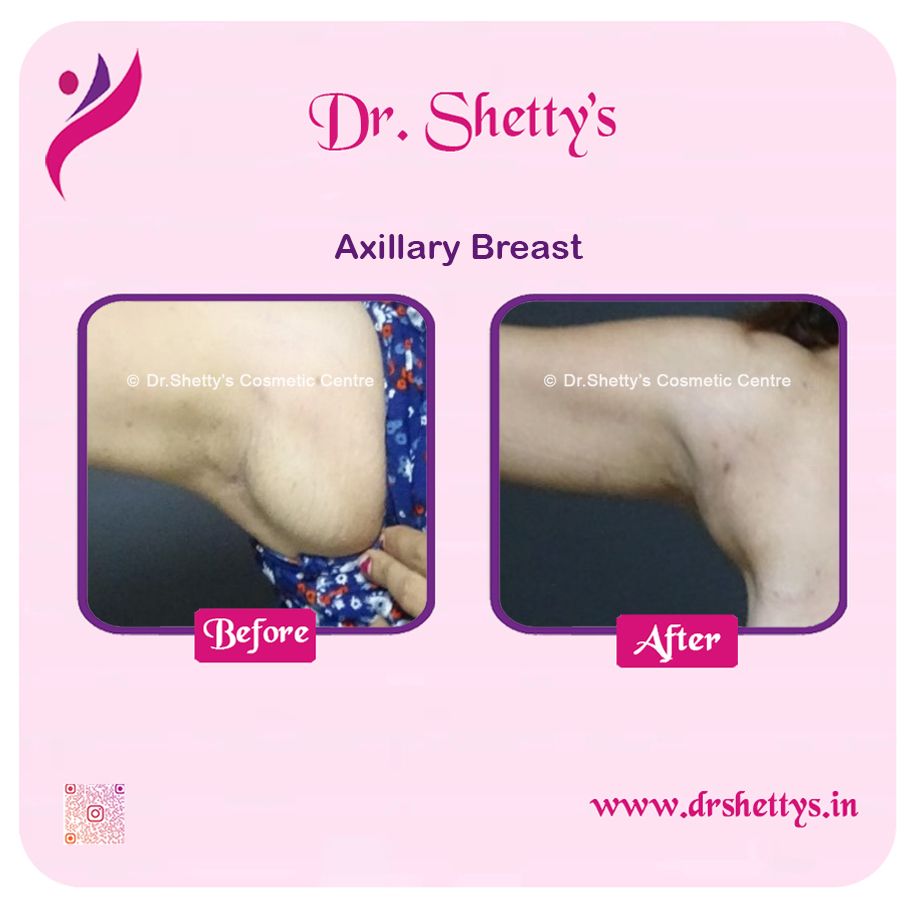 Axillary Breast Surgery 5