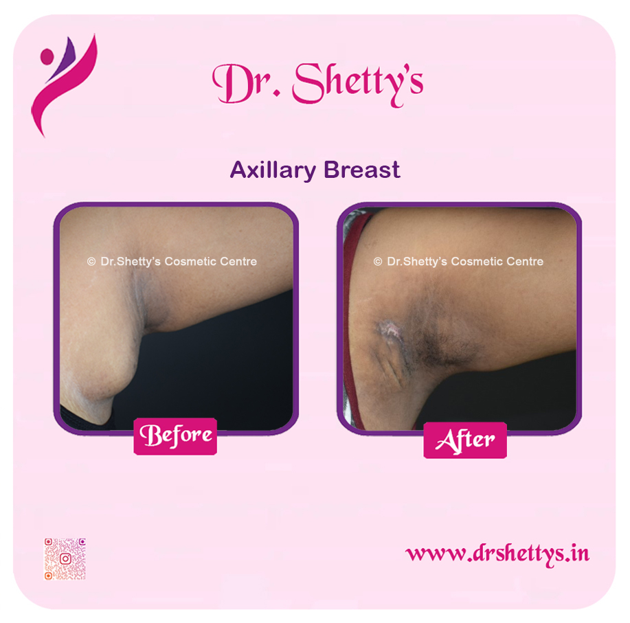 Axillary Breast Surgery 6