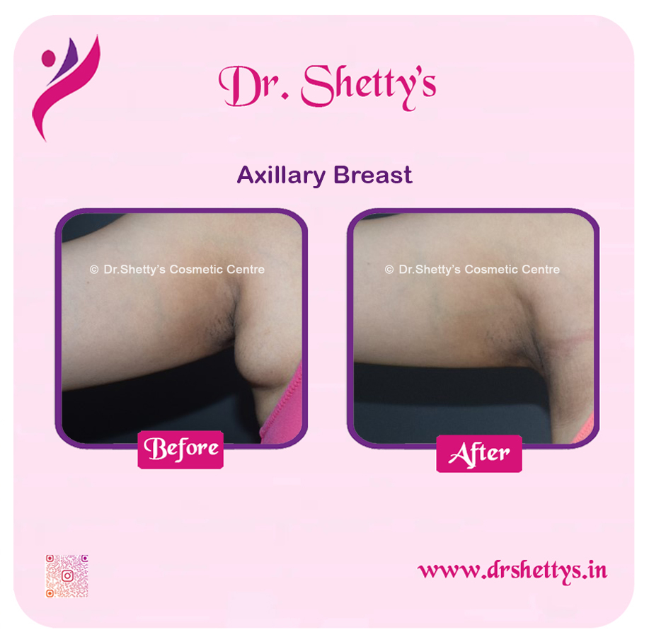 Axillary Breast Surgery 7