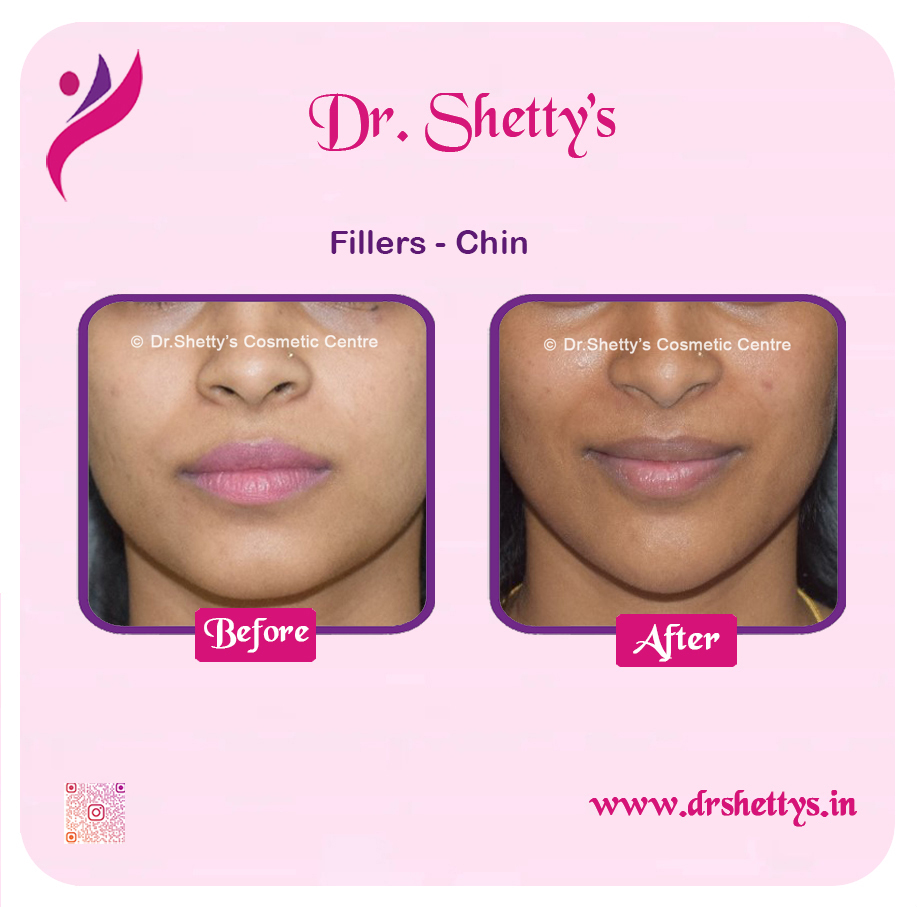 Botox and Fillers Treatment 15