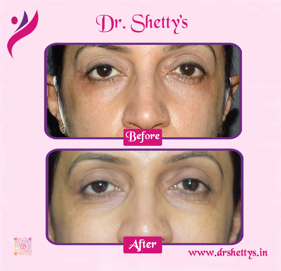 Botox and Fillers Treatment 3
