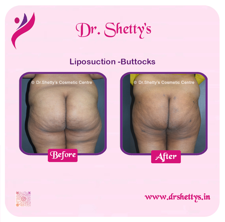 Butt Reduction Surgery 1
