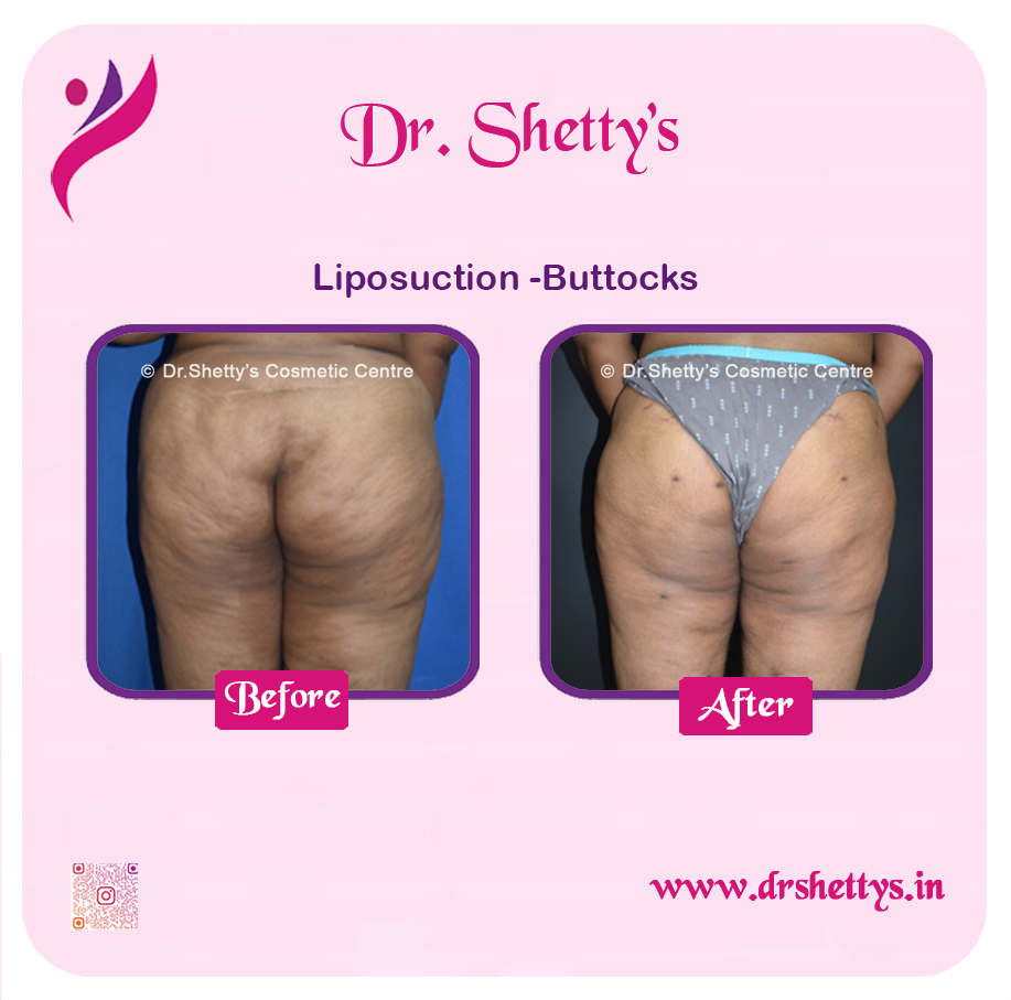 Butt Reduction Surgery 2