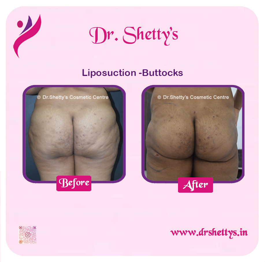 Butt Reduction Surgery 3