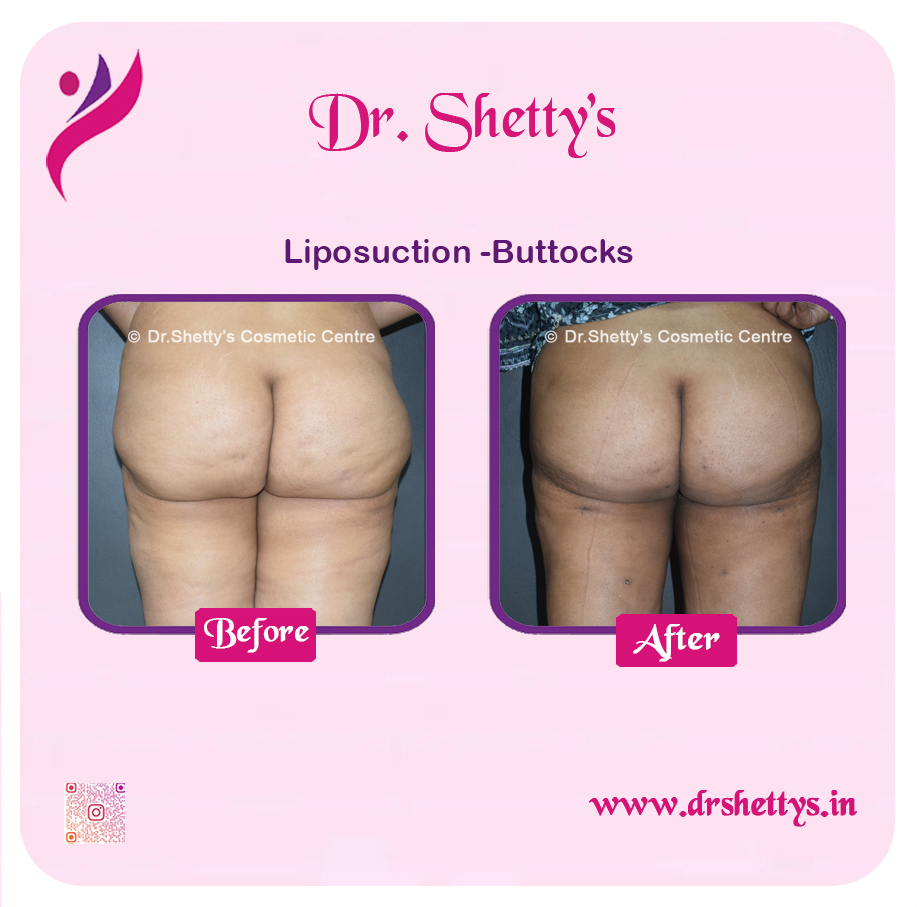 Butt Reduction Surgery 4