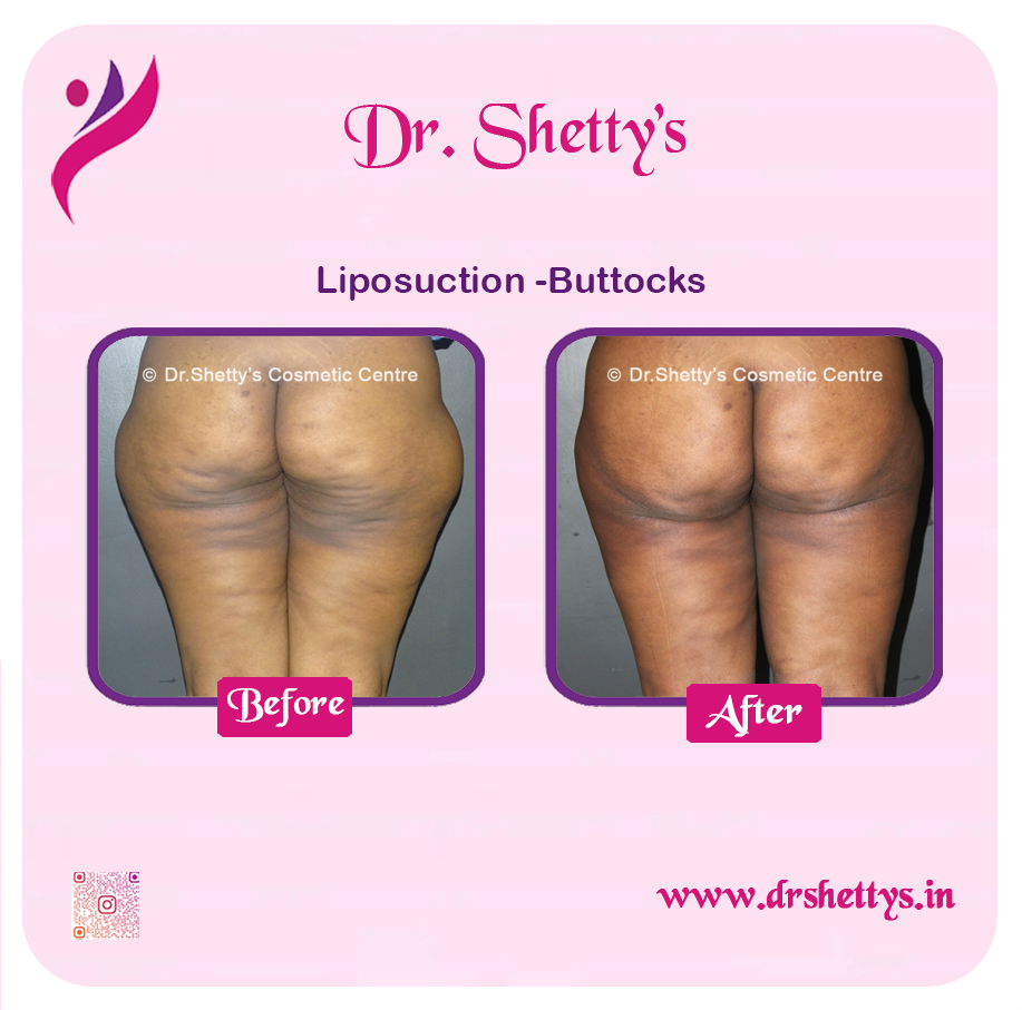 Butt Reduction Surgery 5