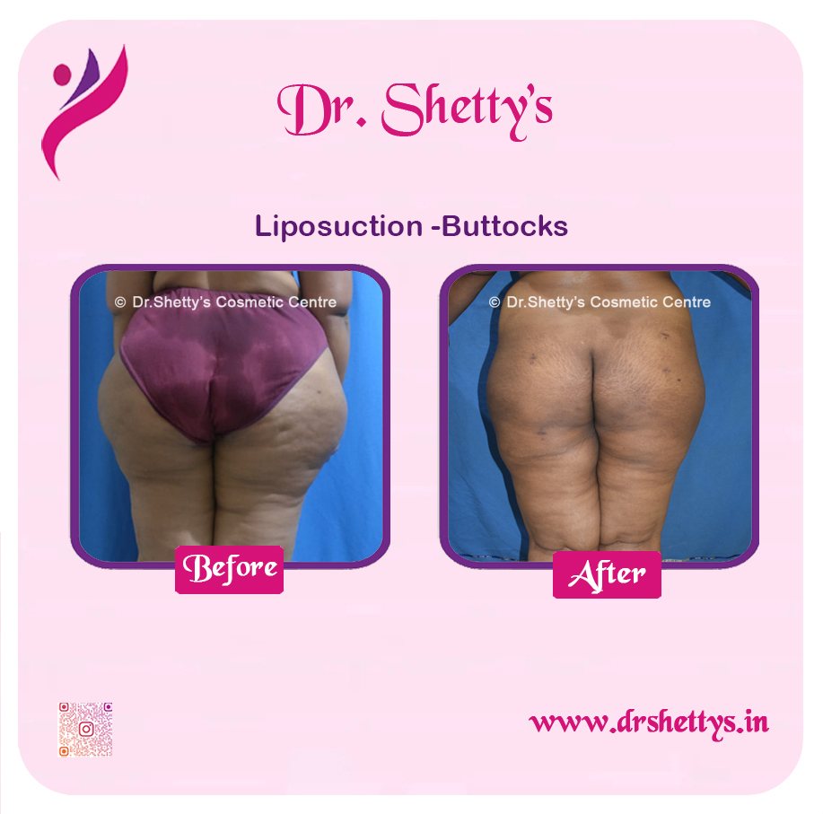 Butt Reduction Surgery 6