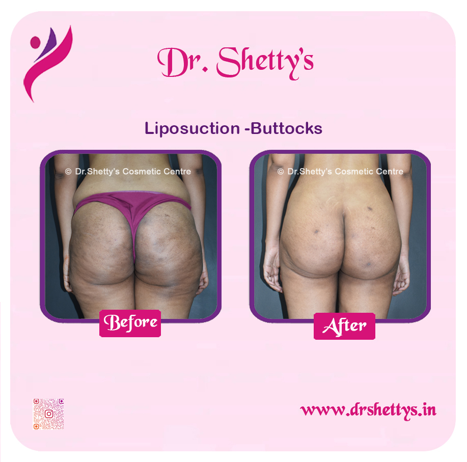 Butt Reduction Surgery 7
