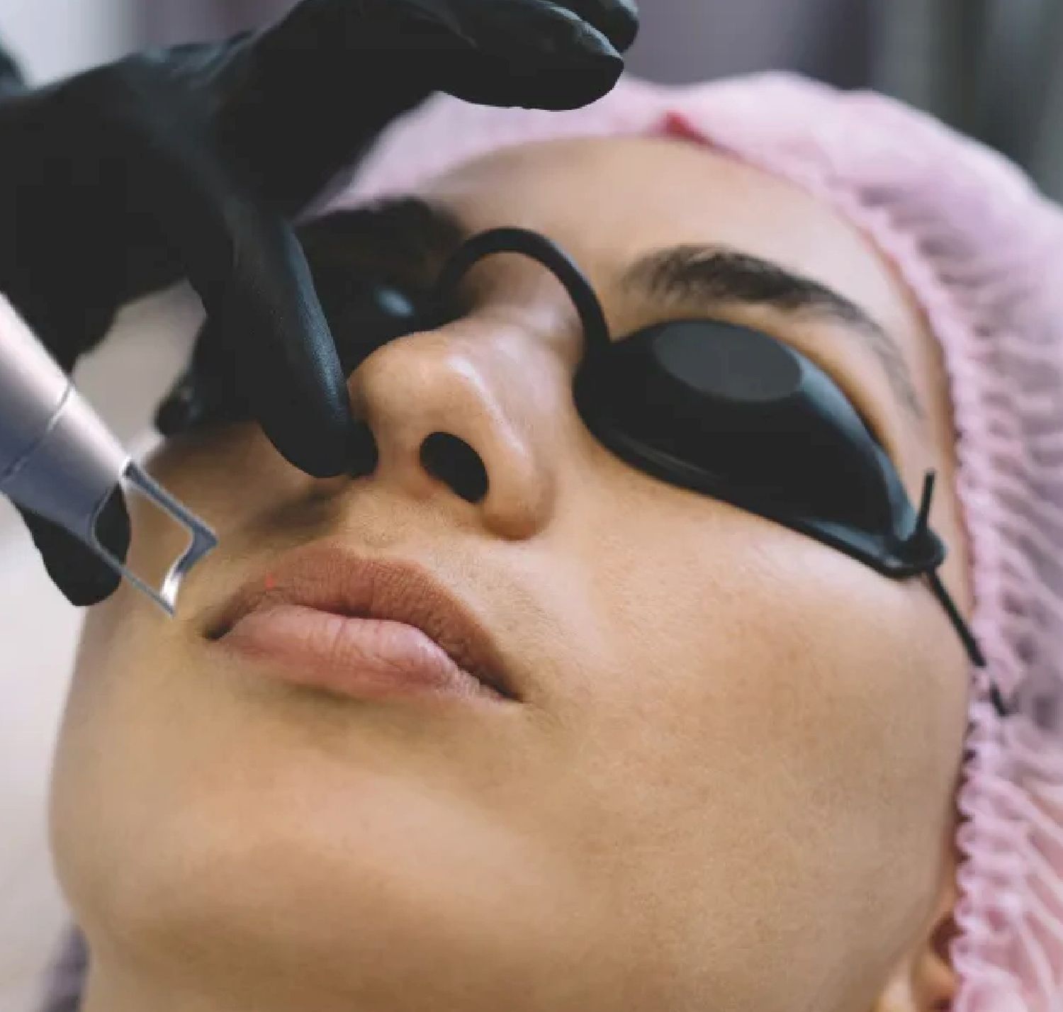 CO2 Laser Resurfacing