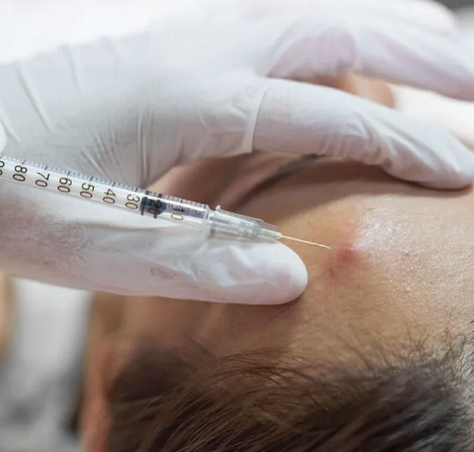 Corticosteroid Injections