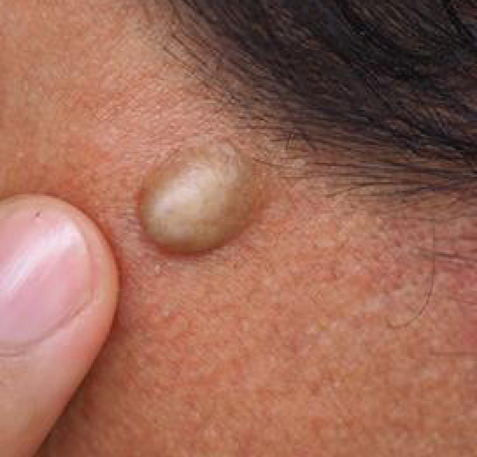 Dermoid Cyst Removal