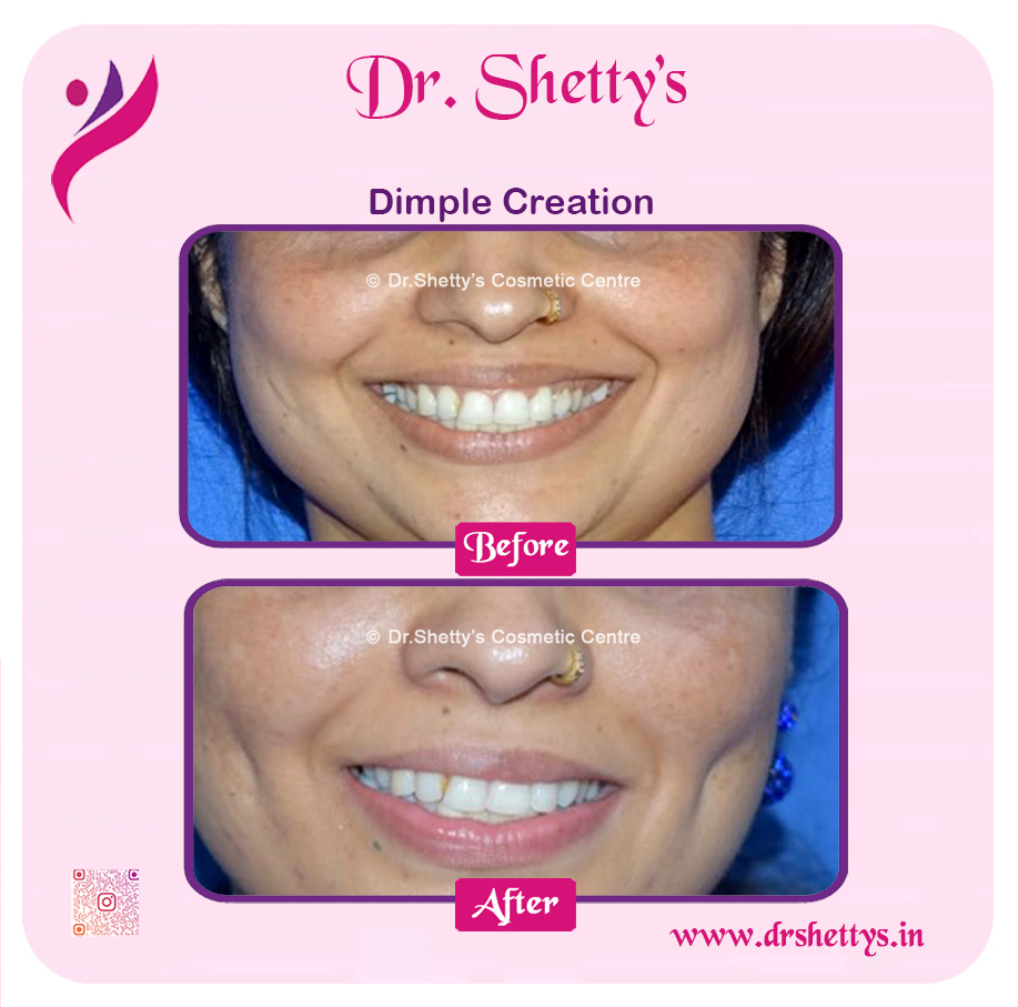 Dimple Creation Surgery 1