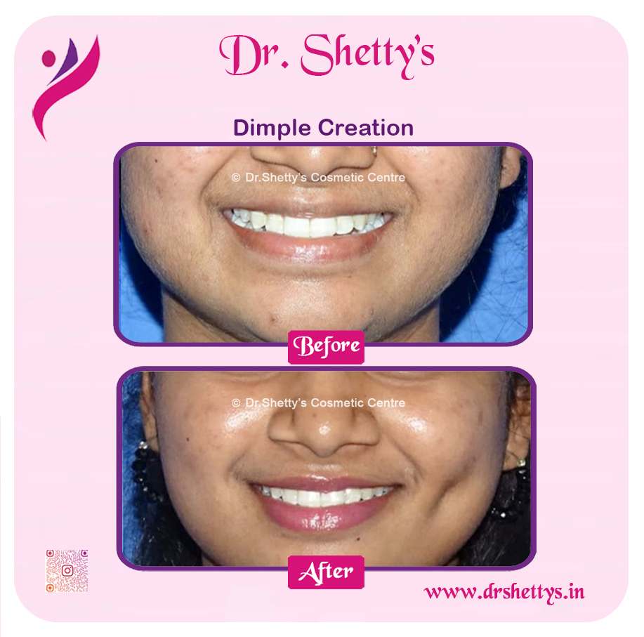 Dimple Creation Surgery 2