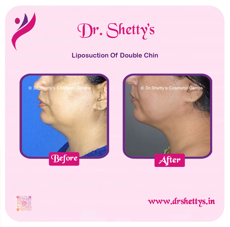 Double Chin Liposuction 1