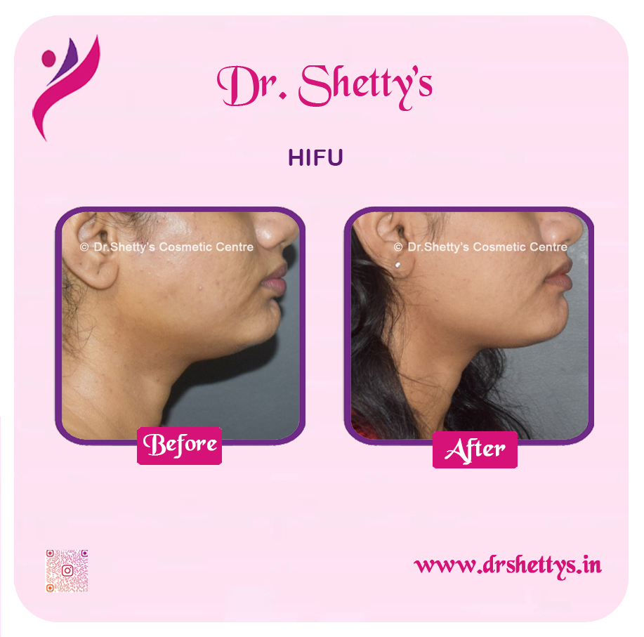 Double Chin Liposuction 10