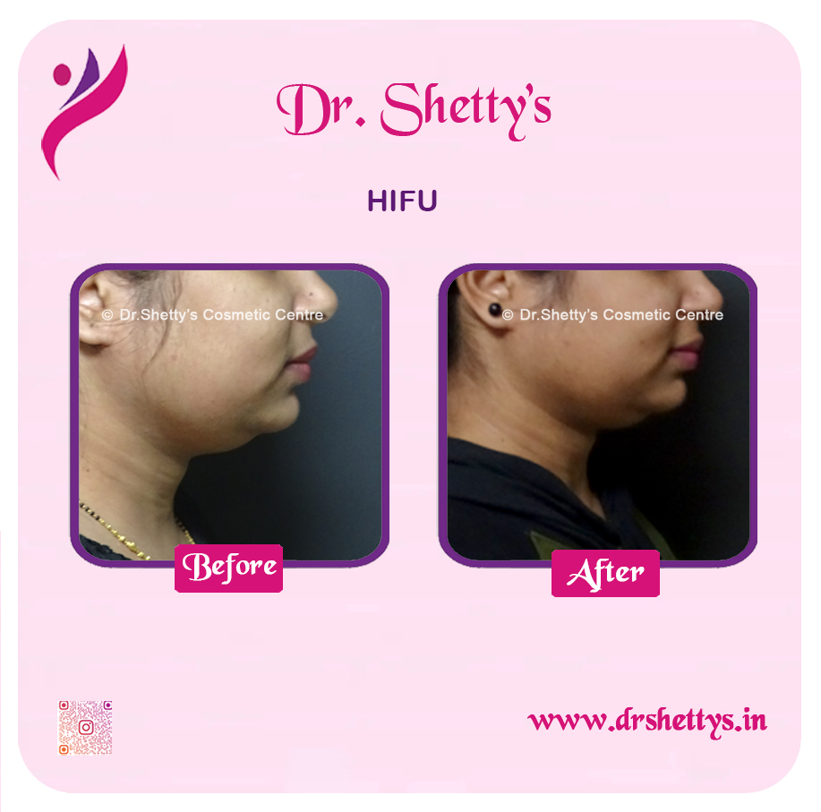 Double Chin Liposuction 11