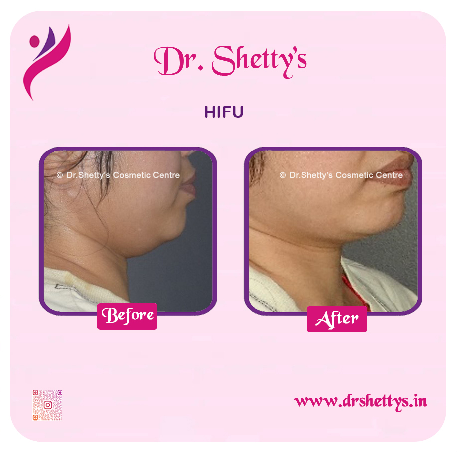 Double Chin Liposuction 12