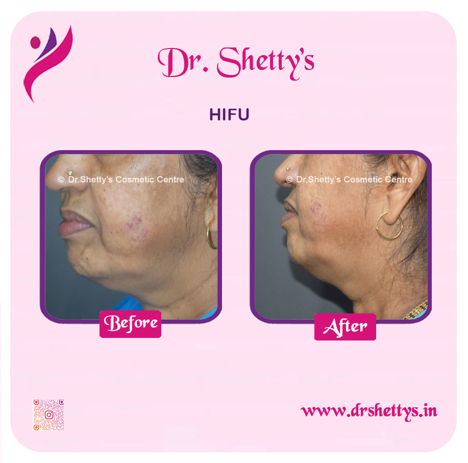 Double Chin Liposuction 13