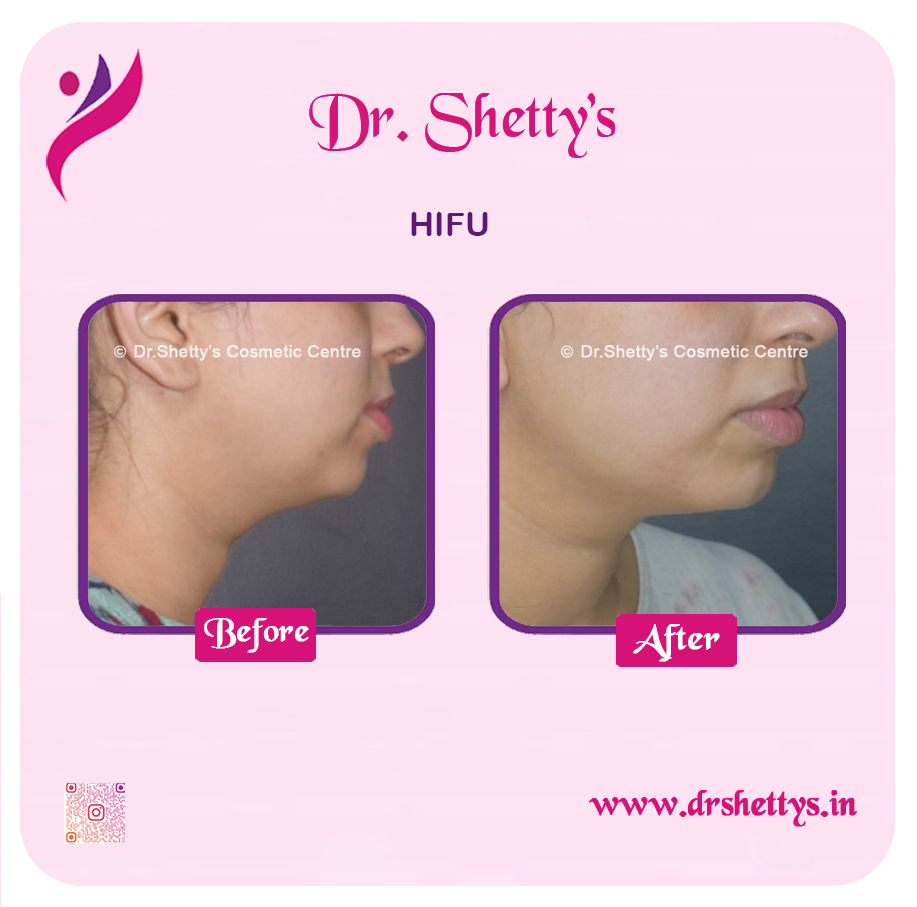 Double Chin Liposuction 14