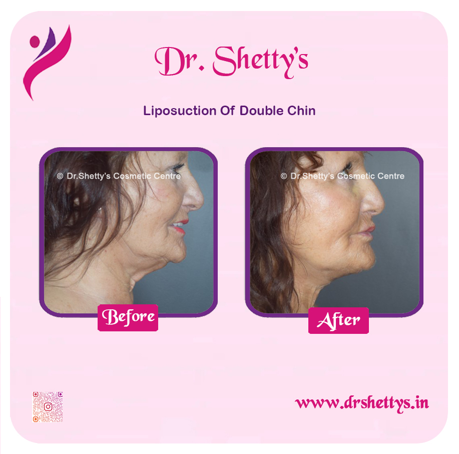 Double Chin Liposuction 2