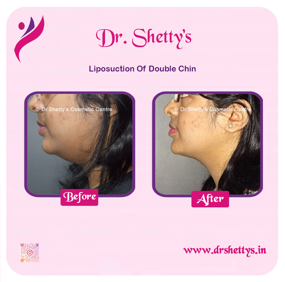 Double Chin Liposuction 3