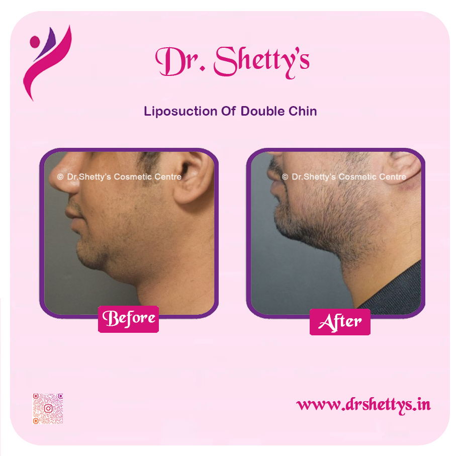 Double Chin Liposuction 4