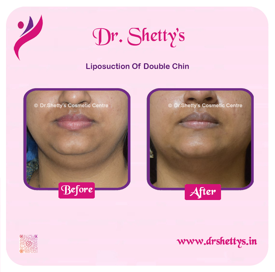 Double Chin Liposuction 6