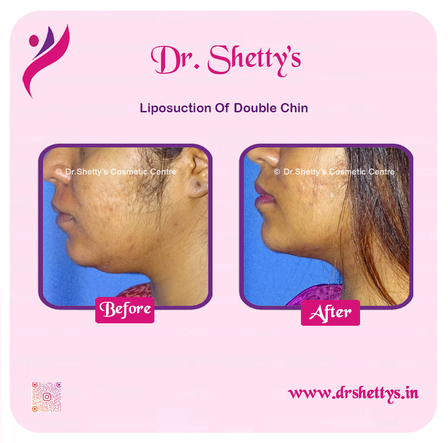 Double Chin Liposuction 7