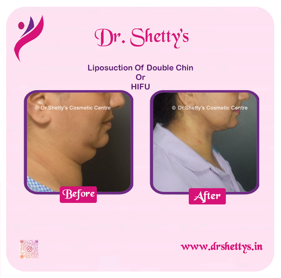 Double Chin Liposuction 9