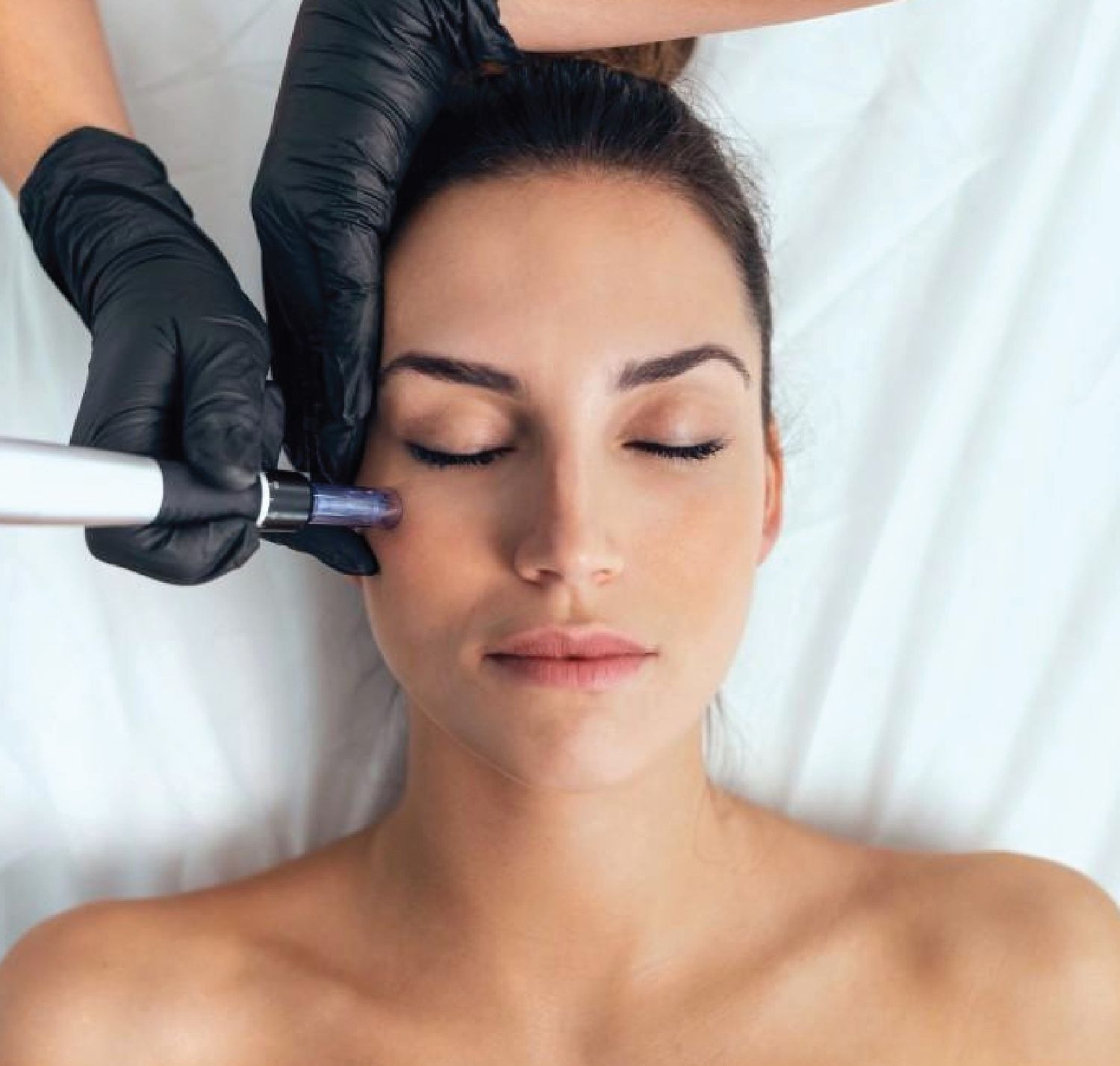 Dual Mode RF Therapy for Active Acne Scars