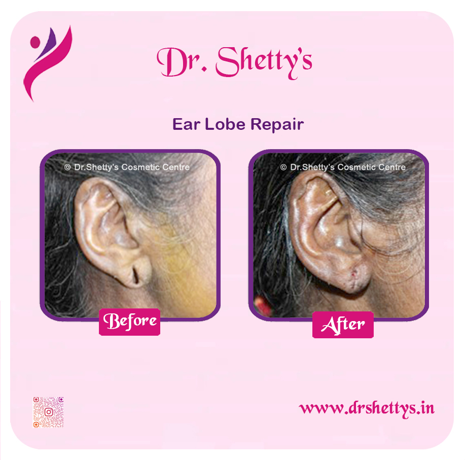 EarLobe 01