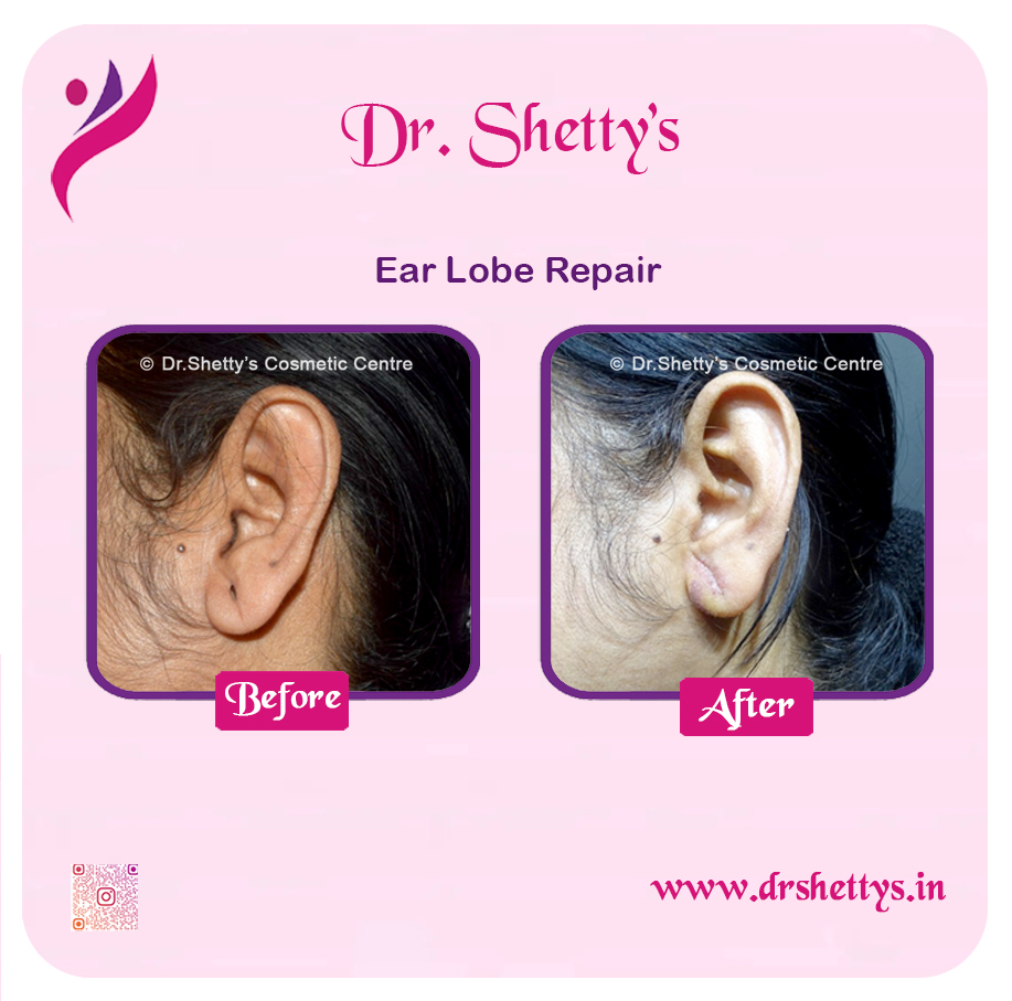 EarLobe 02