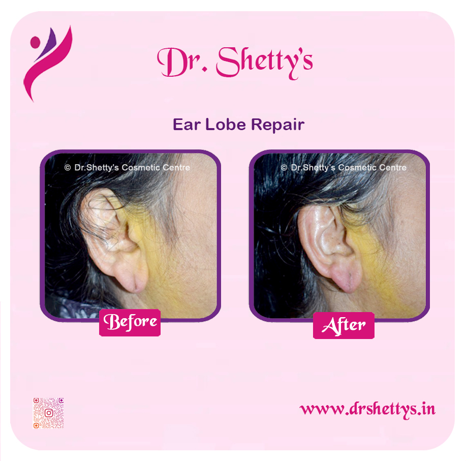 EarLobe 03