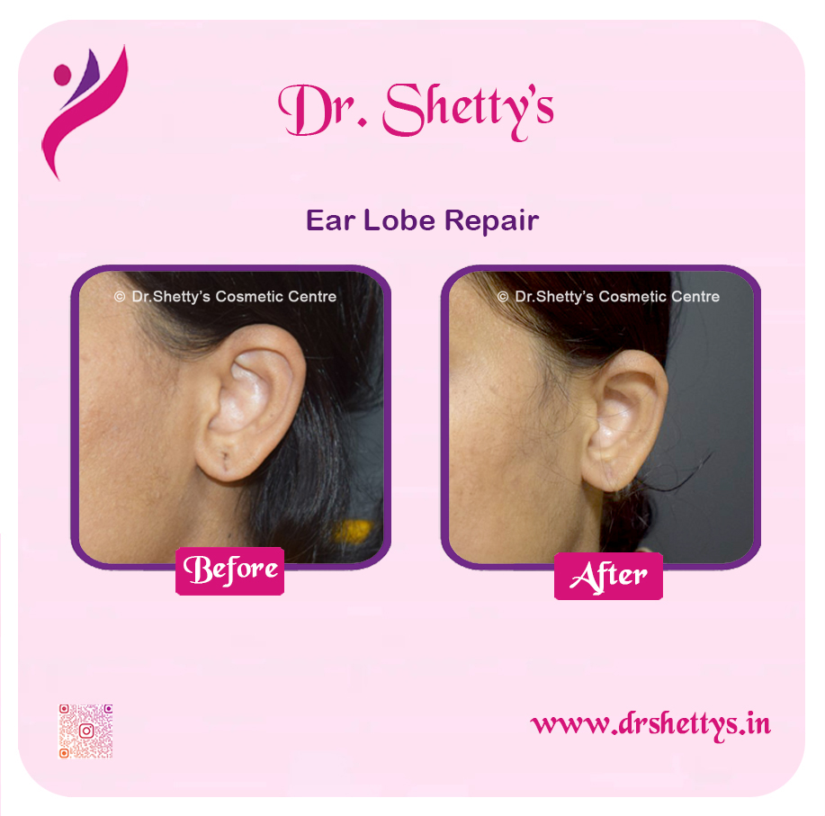 EarLobe 04