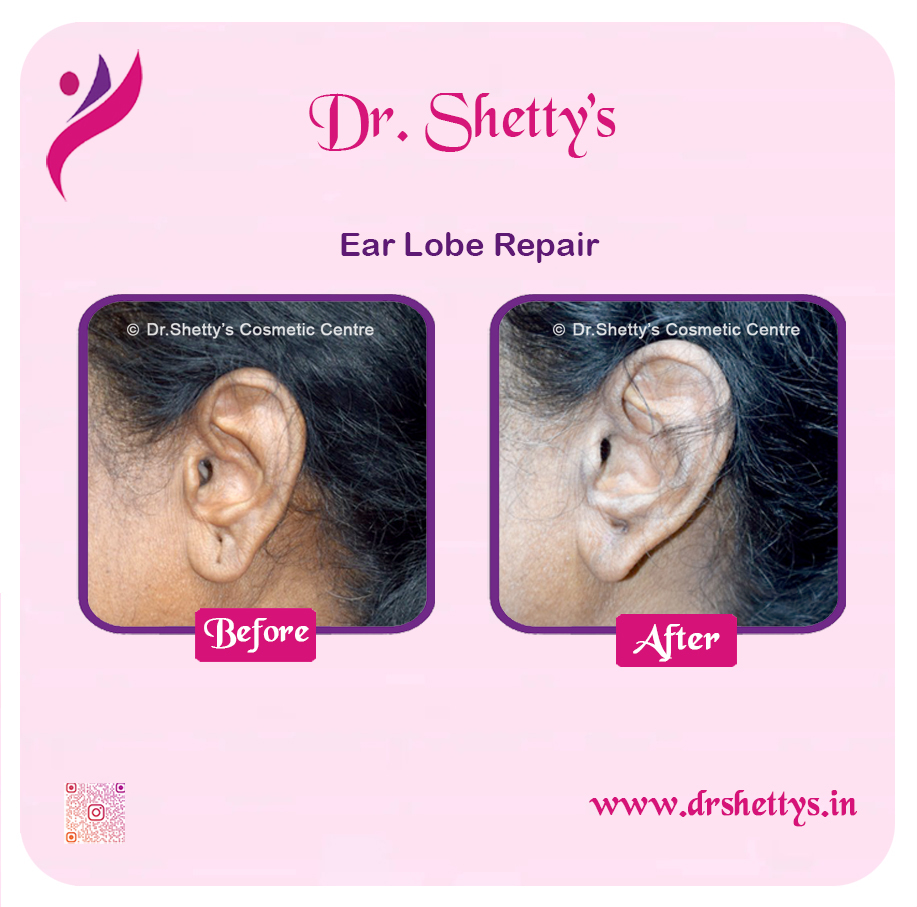 EarLobe 05