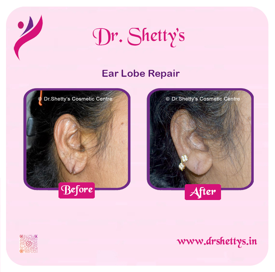 EarLobe 07