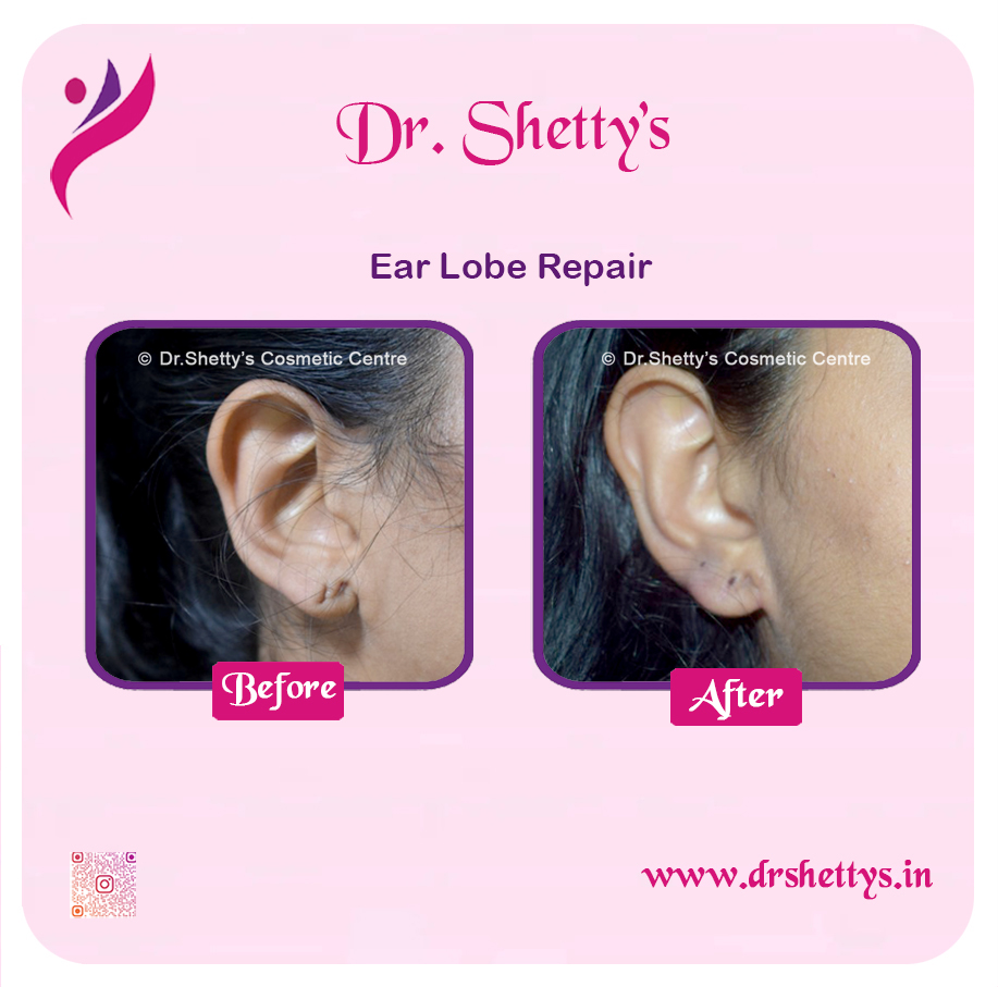 EarLobe 08