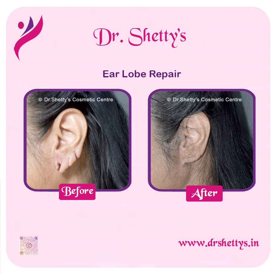 EarLobe 09
