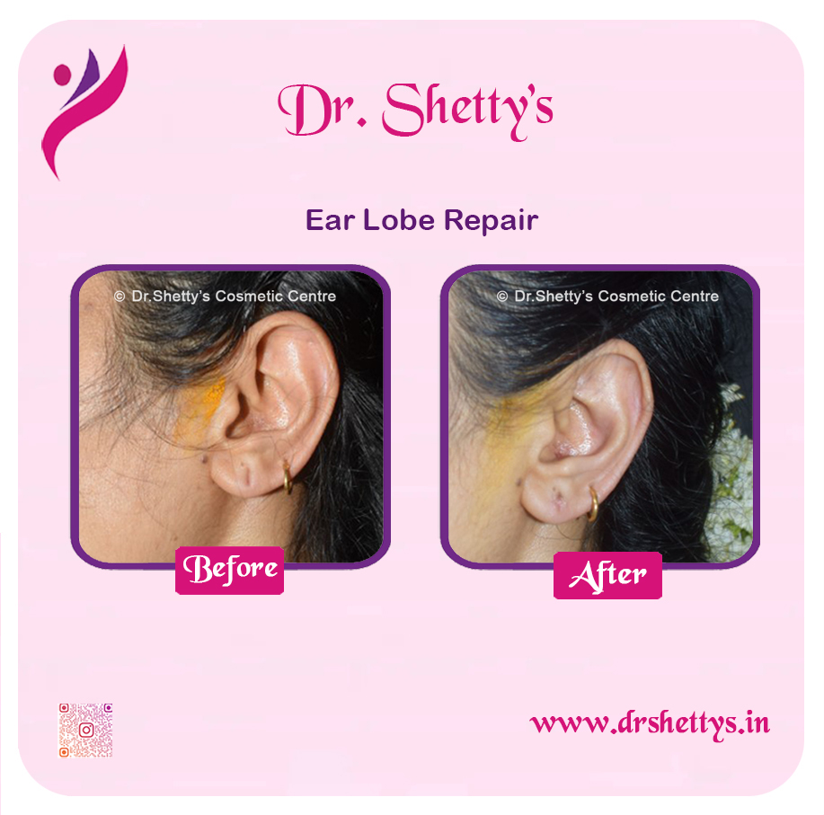 EarLobe 10