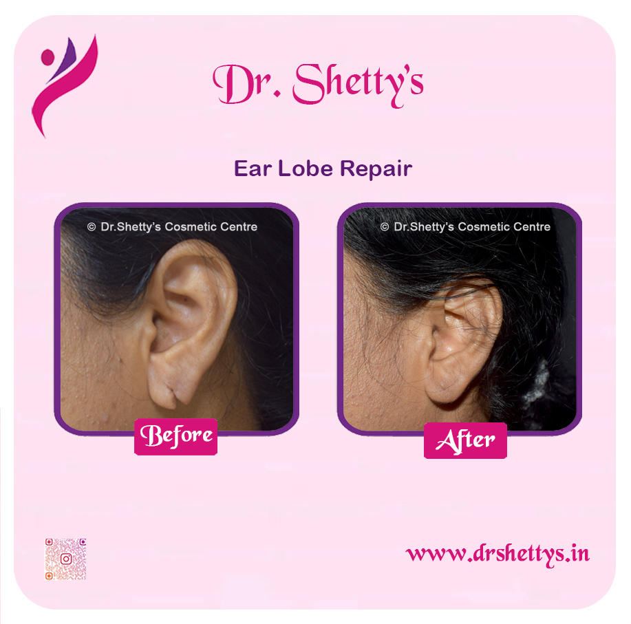 EarLobe 11