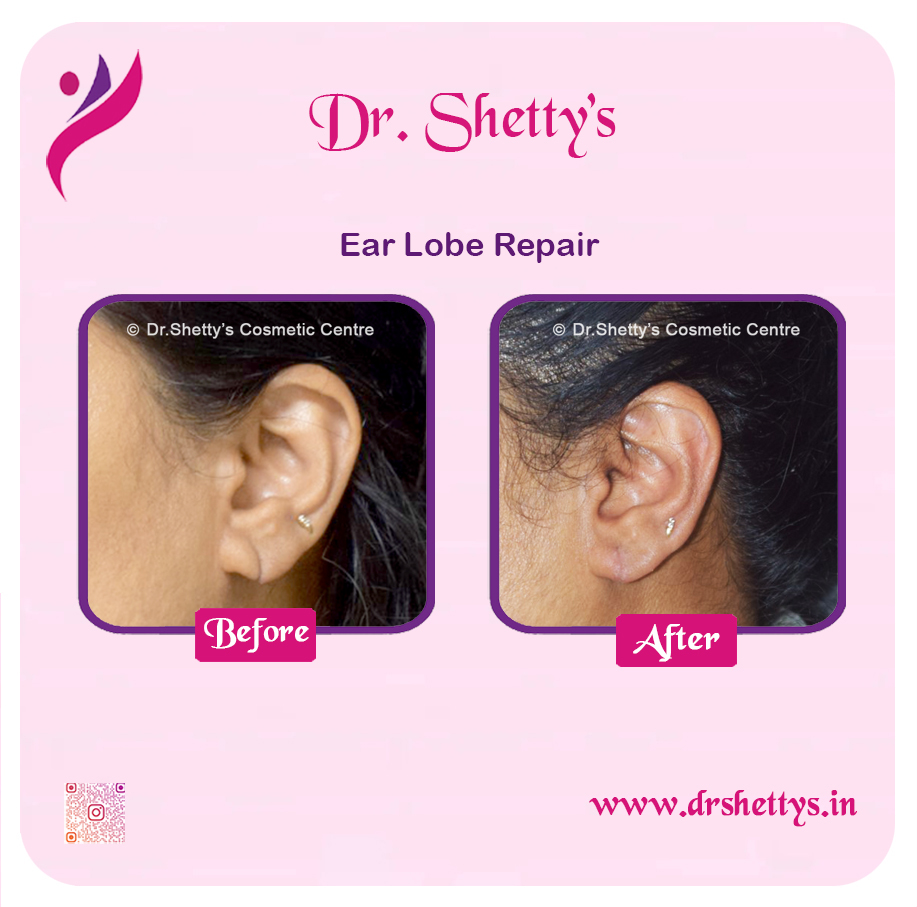 EarLobe 12