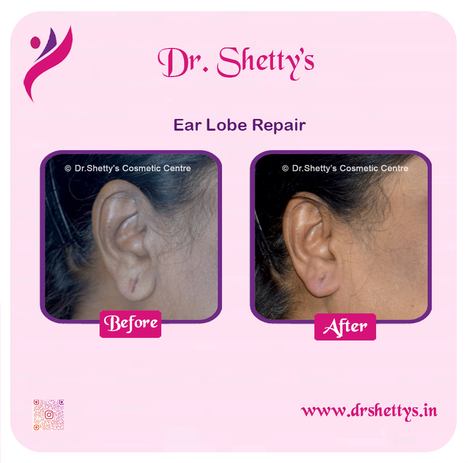 EarLobe 13